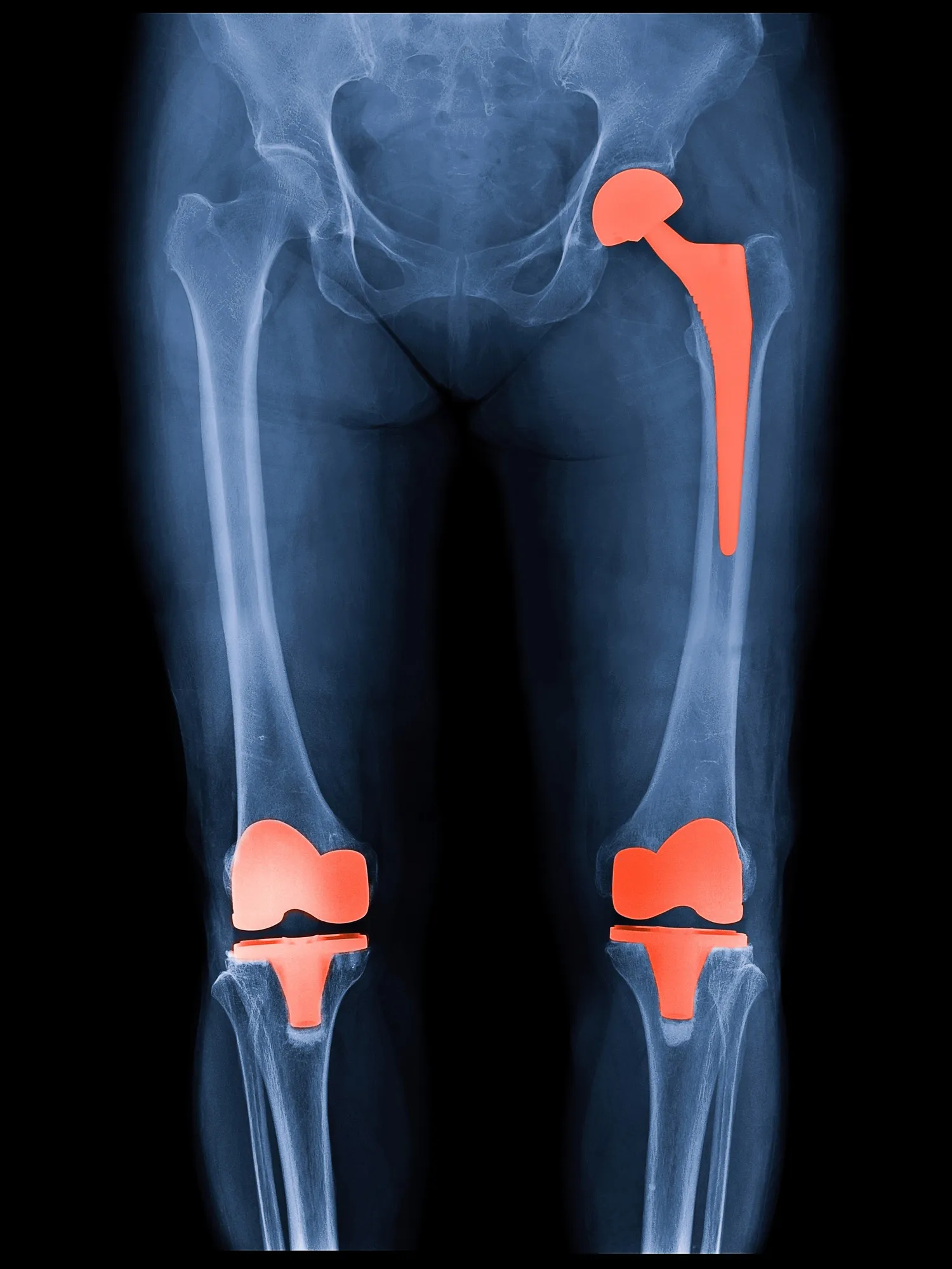 Joint Replacement Surgery
