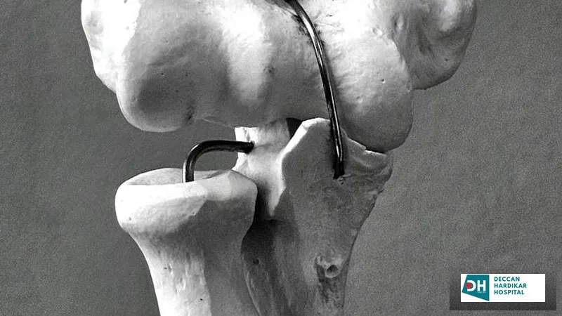 Ligament Tear vs. Muscle Strain: How to Tell the Difference