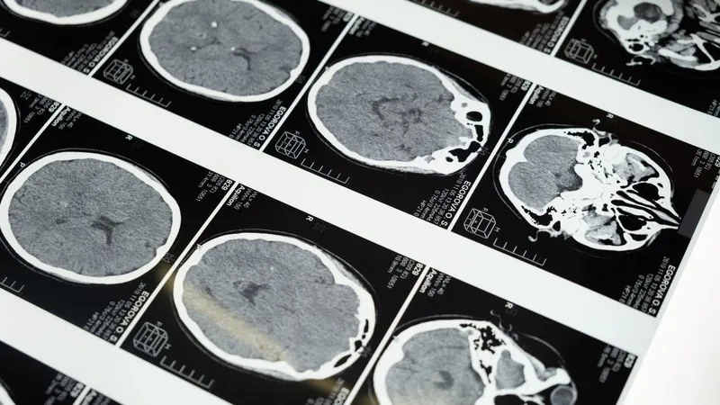 Brain Tumour Symptoms, Diagnosis, and Treatment: A Patient Guide