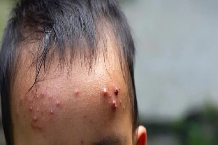 Skin & hair Diseases