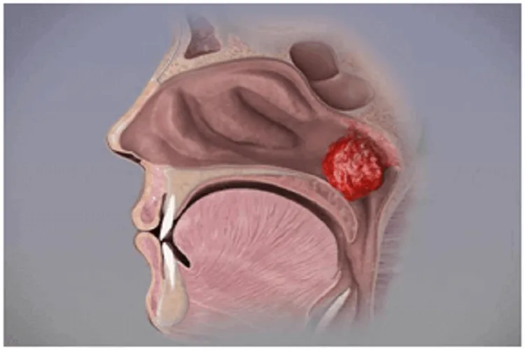 Nasopharyngeal Tonsils