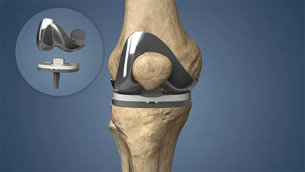 Total Knee Replacement Surgery in Pune | Patient Story