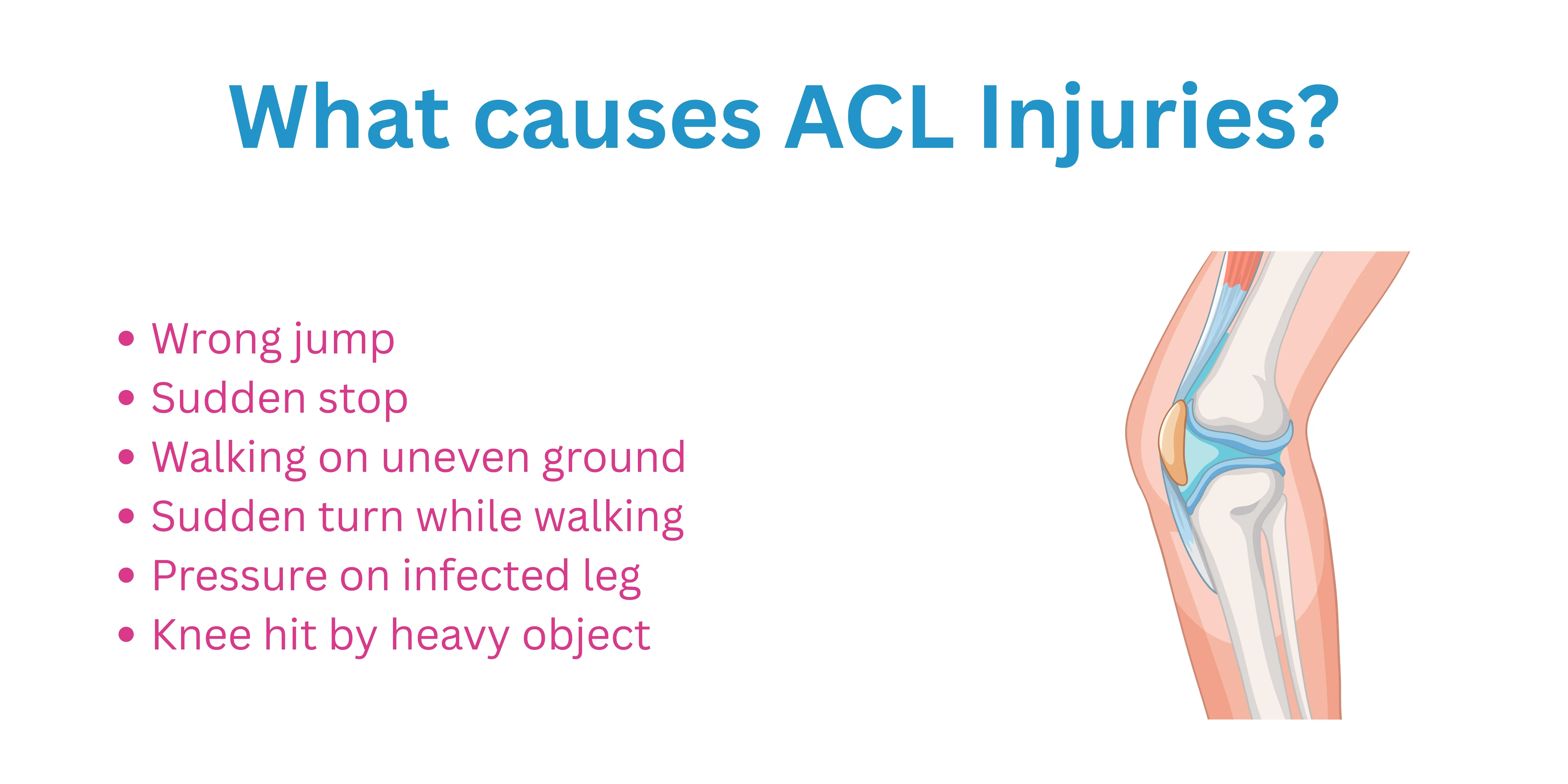 What causes ACL injuries