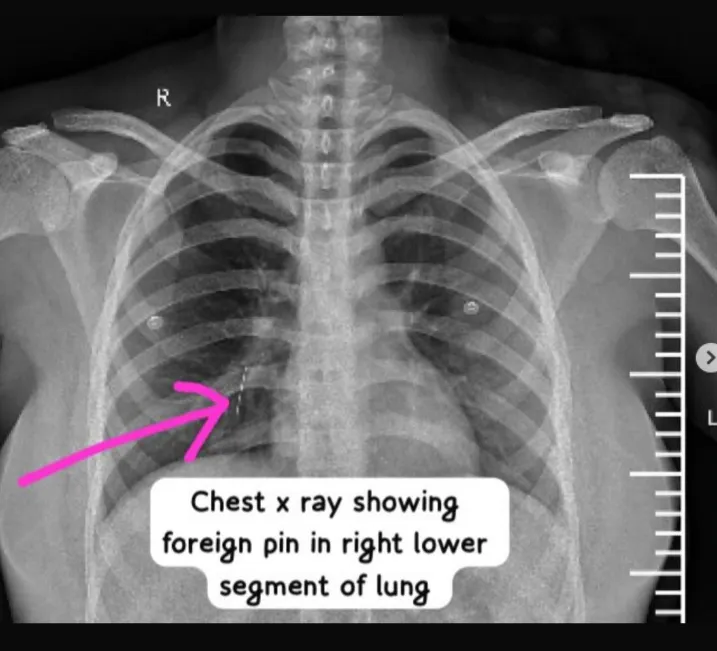 pin inhalation is a medical emergency