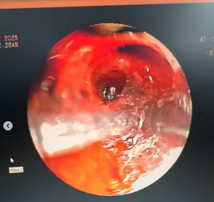 pin inhalation is a medical emergency