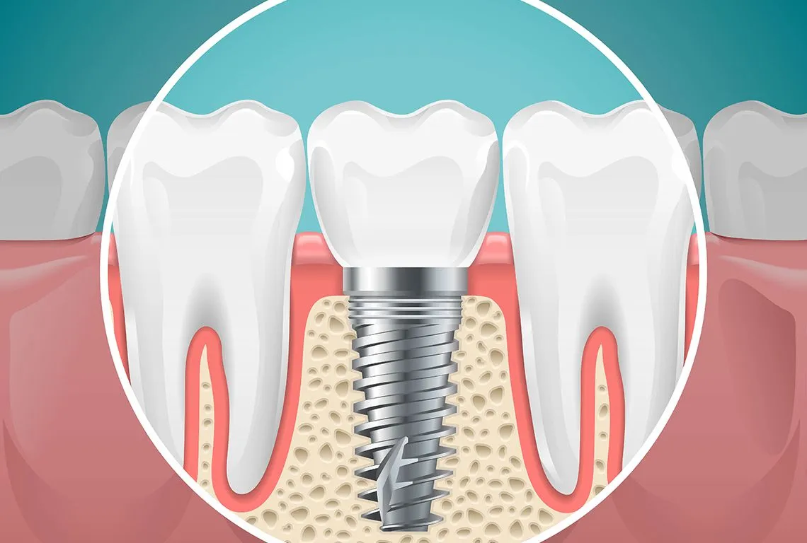 Dental and Implant Care