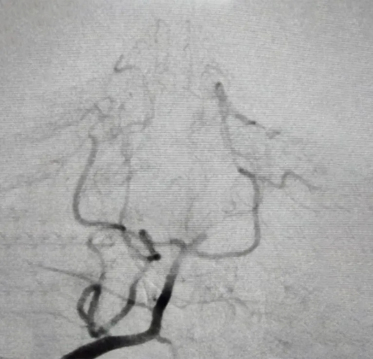 Cerebral DSA  - Pre Thrombectomy.jpg