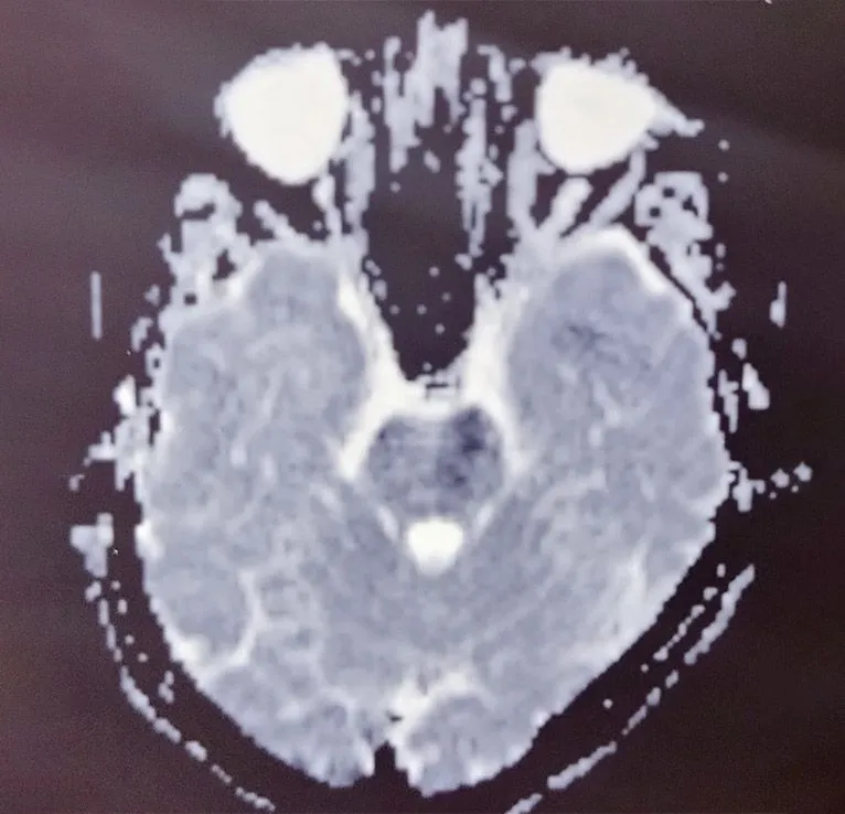 MRI DWI.jpg