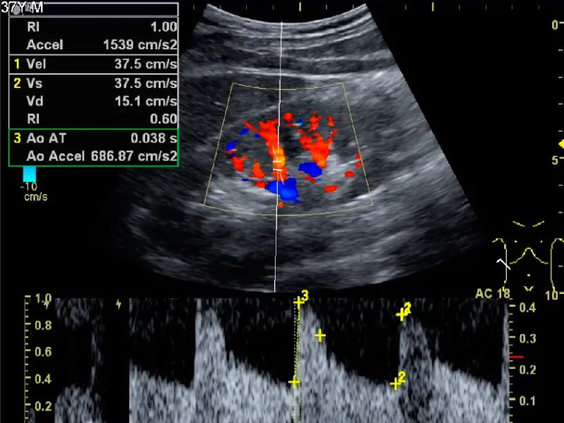 Renal Doppler