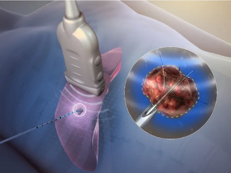 EP Study RFA Ablation