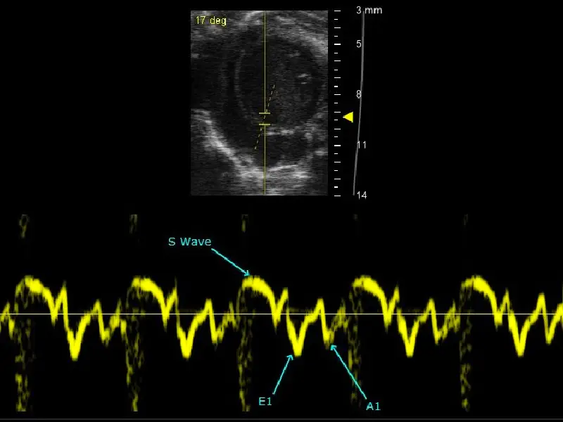 Tissue Doppler Imaging
