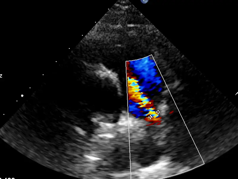 2-D Echo Colour Doppler