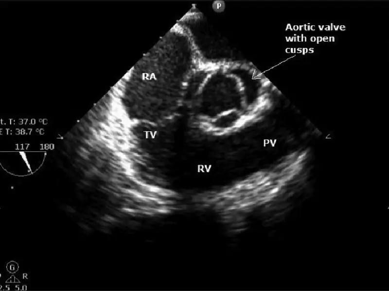 Transoesophageal Echo TEE