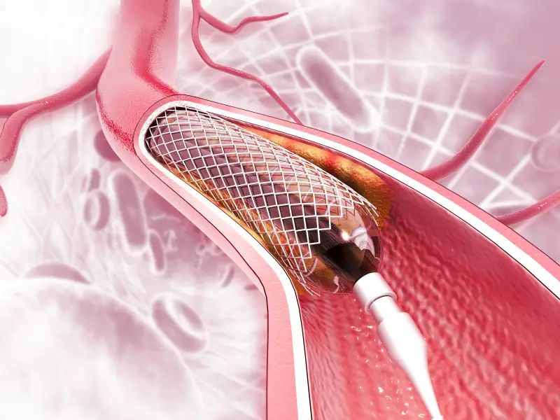 Coronary Angioplasty