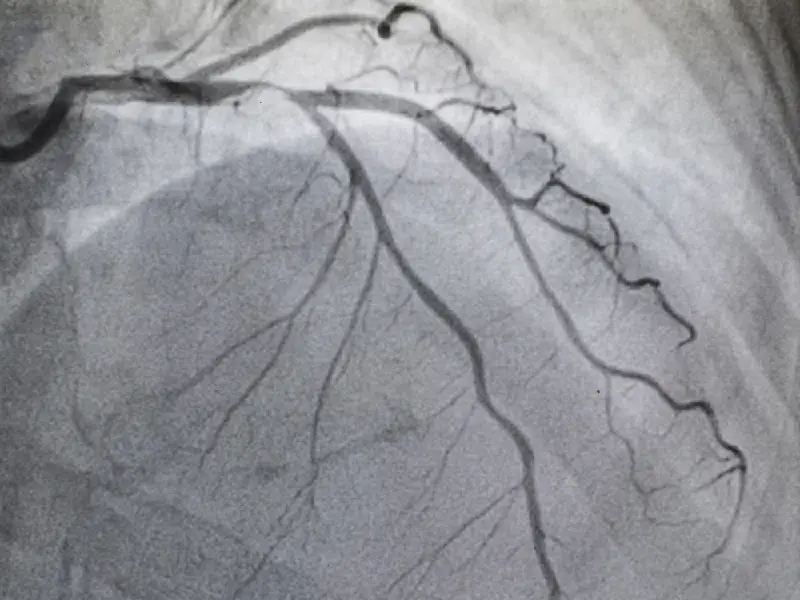 Coronary Angiography