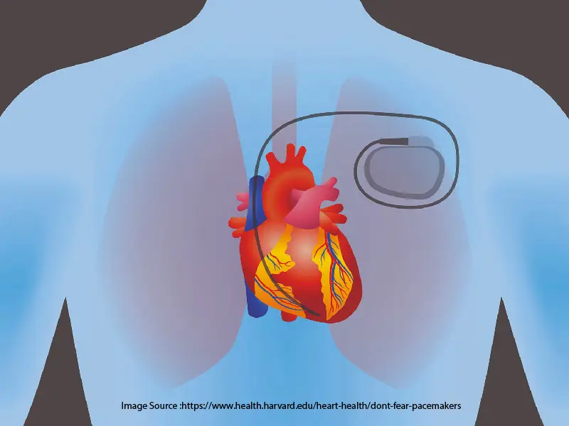 Pacemaker Implantation
