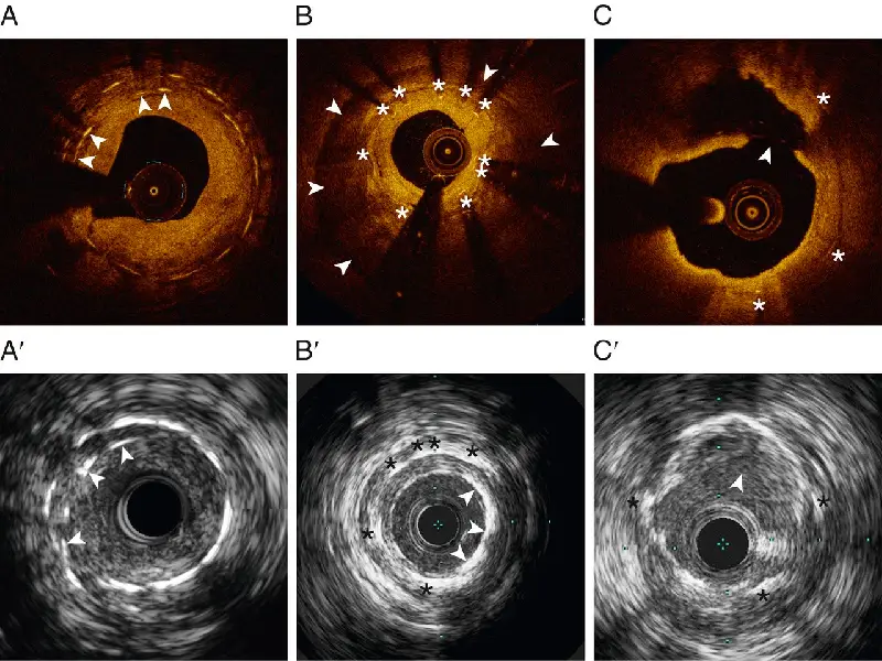 IVUS Intravascular Ultrasound