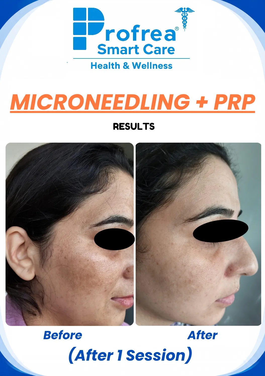 prp hair treatment before and after