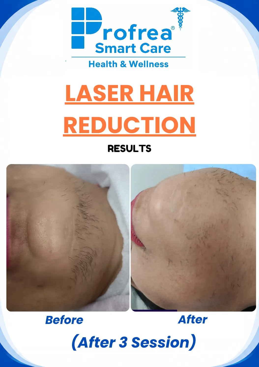 before and after results of profrea