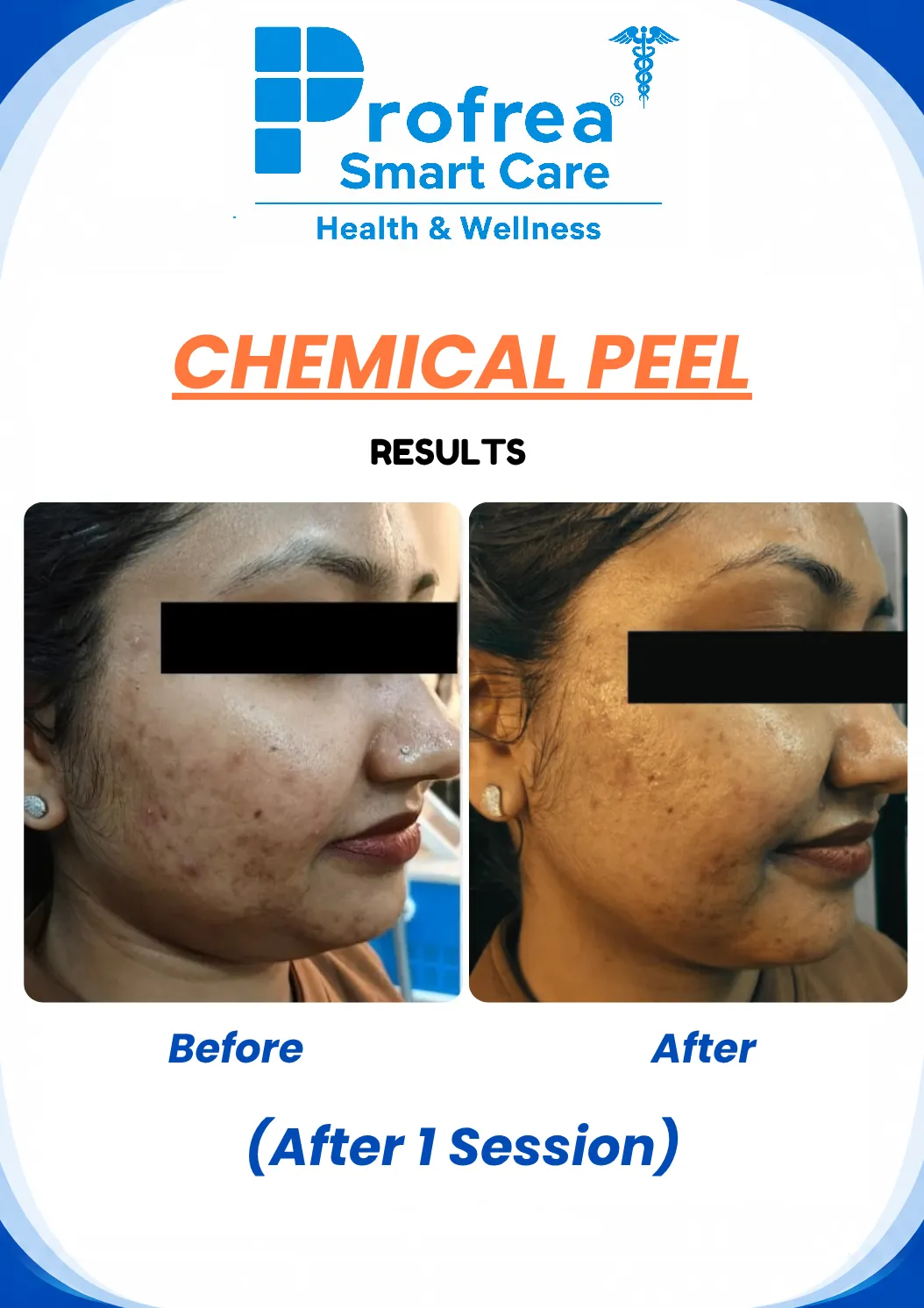 chemical peel before and after