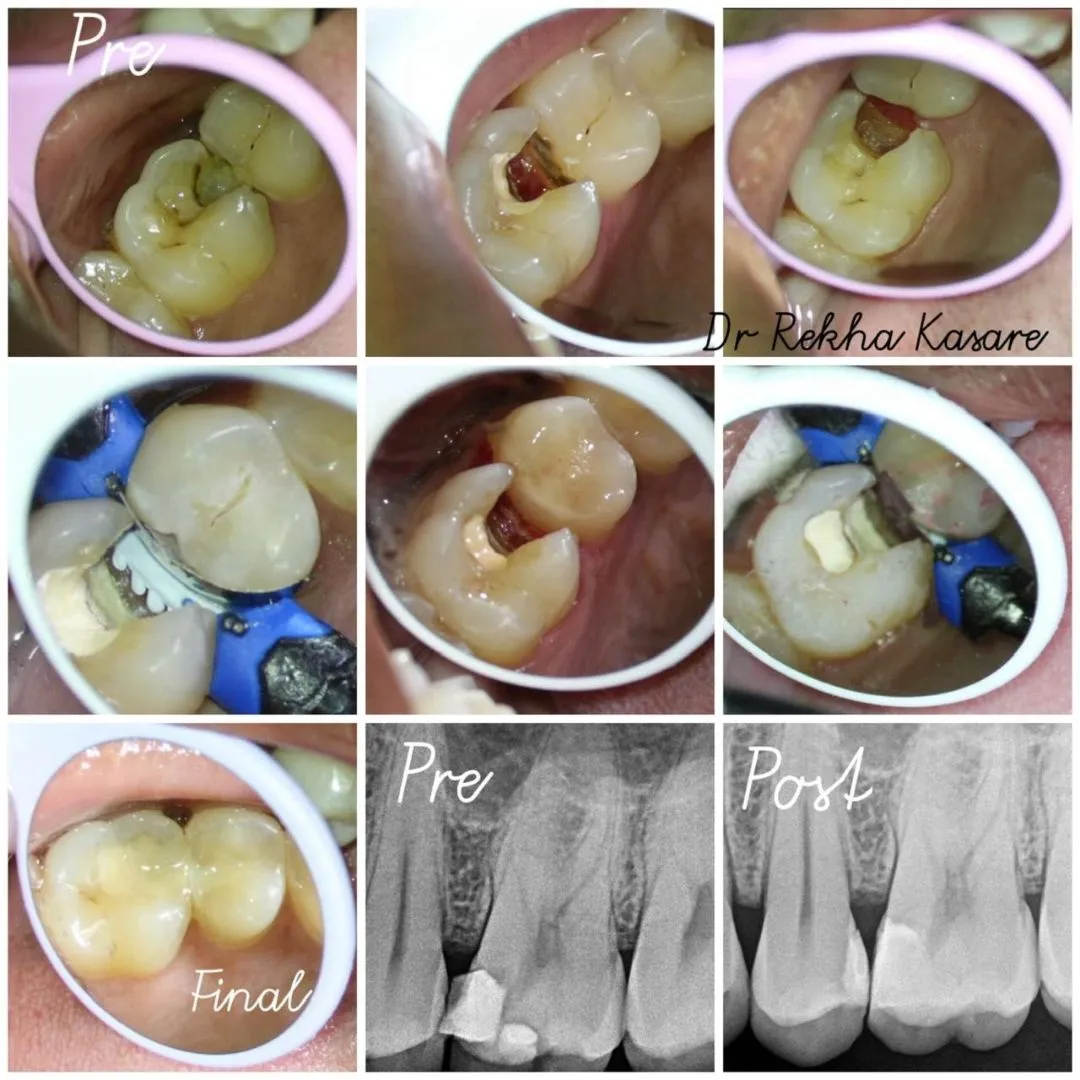 cavity treatment in shivaji nagar, Yavatmal