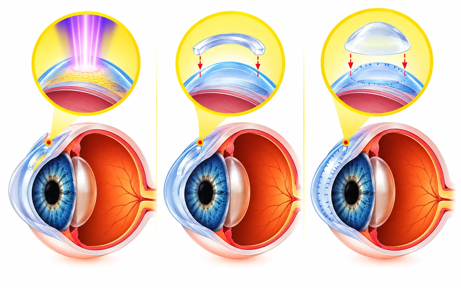 Keratoconus treatment in Delhi
